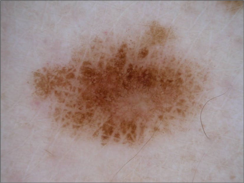 /machine-learning-for-isic-skin-cancer-classification-challenge-part-1-ccddea4ec44a feature image