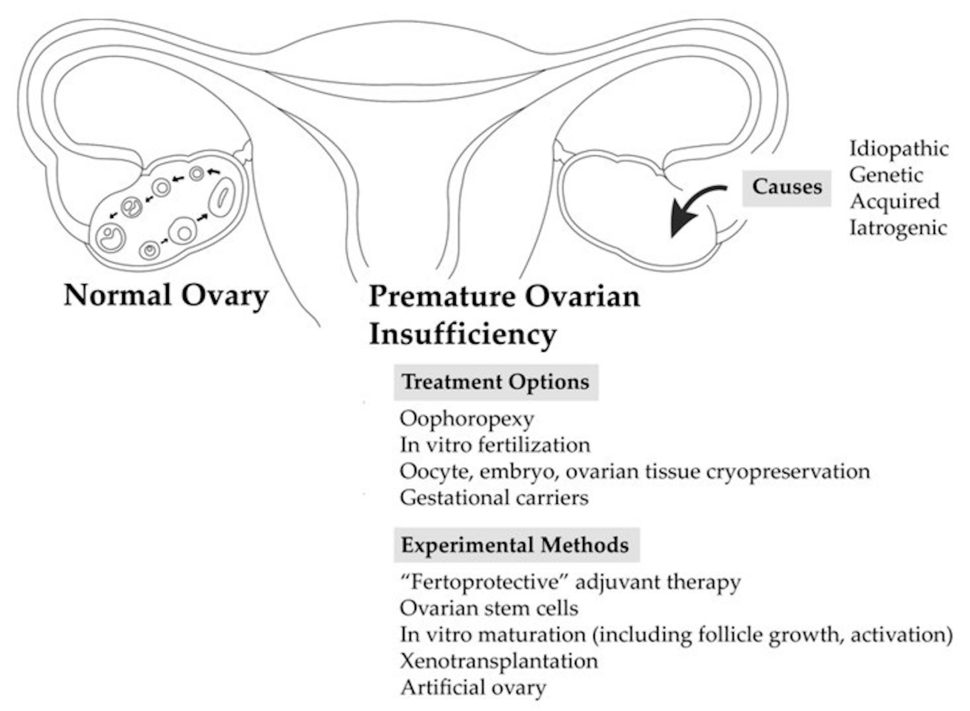 Fertility preservation options in premature ovarian insufficiency.