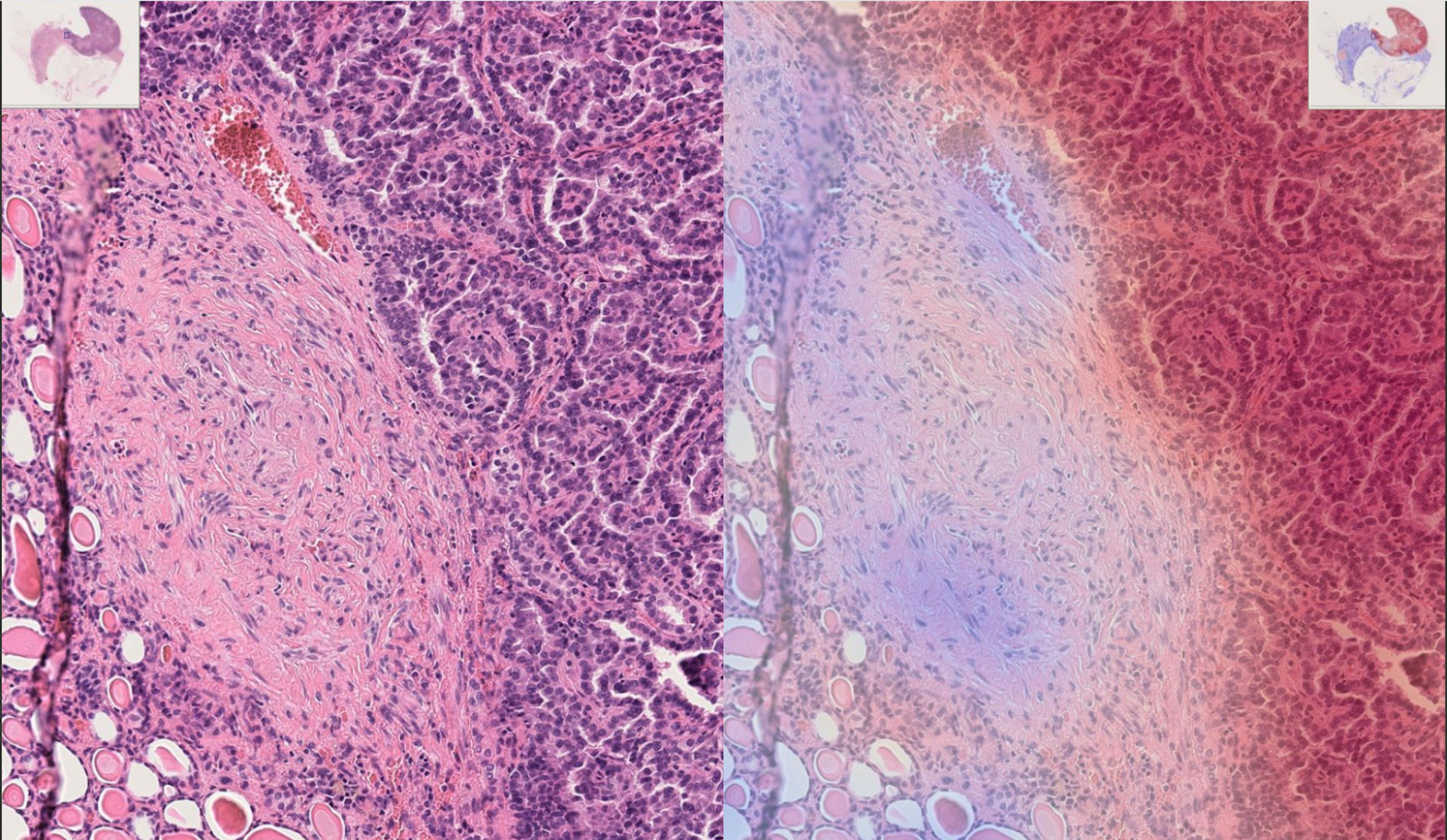 Example of WSI kidney tissue in high resolution (left), with the AI-predicted attention heatmap on the right; Blue color indicates low cancer risk zones, red — high risk.