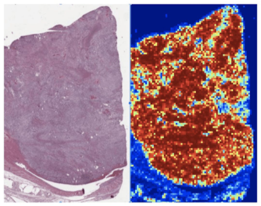 Kidney renal clear cell carcinoma is predicted to be high risk (left), with the AI-predicted “risk heatmap” on the right; red patches correspond to “high-risk” and blue patches to “low-risk”.