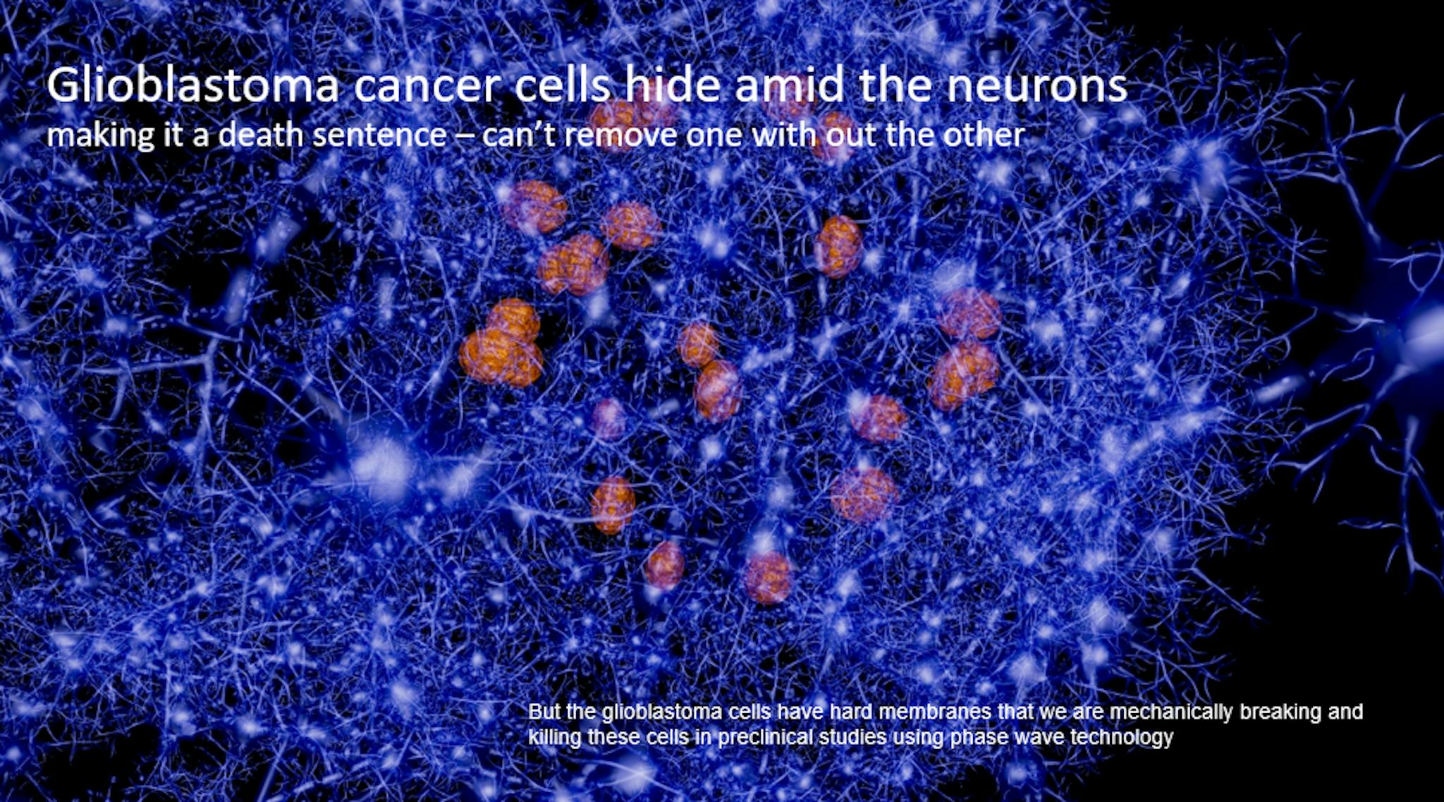 tế bào u nguyên bào thần kinh đệm, , nguồn: https://docs.google.com/document/d/13b2paodoTty7Dk70OEZblaz_ZoQpmSui2HaNrVDOjTc