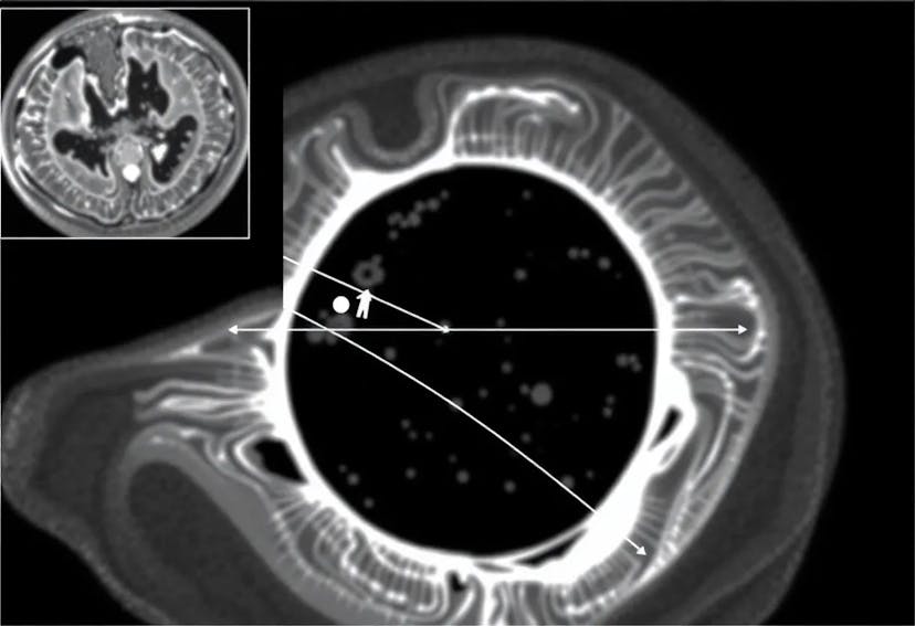 /how-pde-motion-models-boost-image-reconstruction-in-dynamic-ct feature image