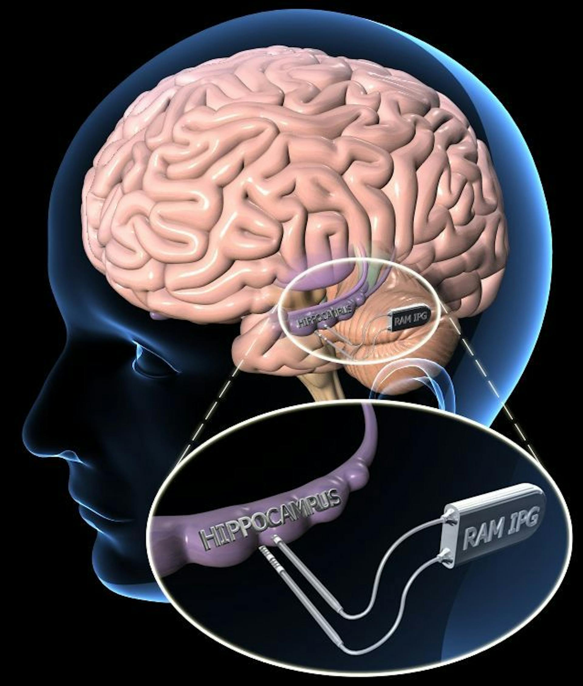 Implantable Neuroprosthesis