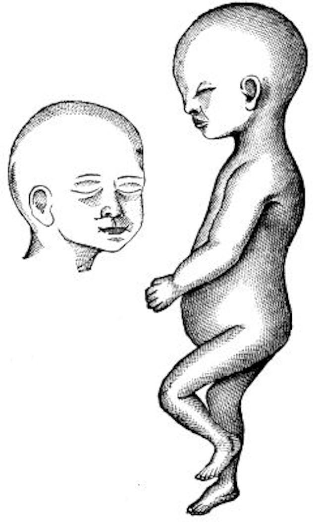 FIG. 3.--Figure of infant at birth; a, front of face. (Theeye is too far posterior in this figure.)