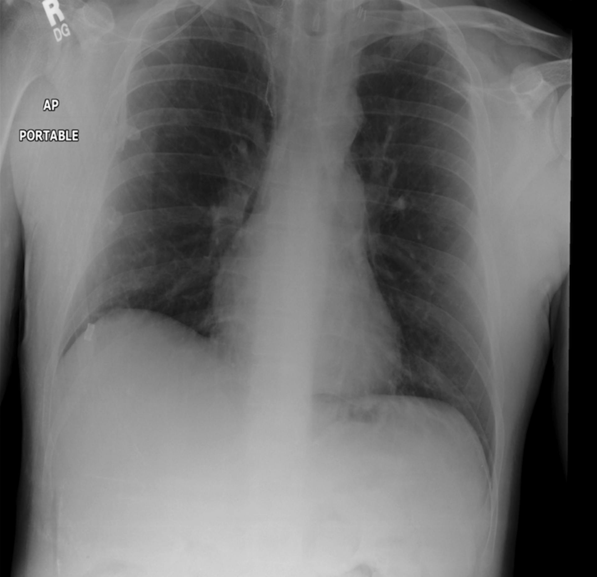 An example image from the chest X-ray dataset