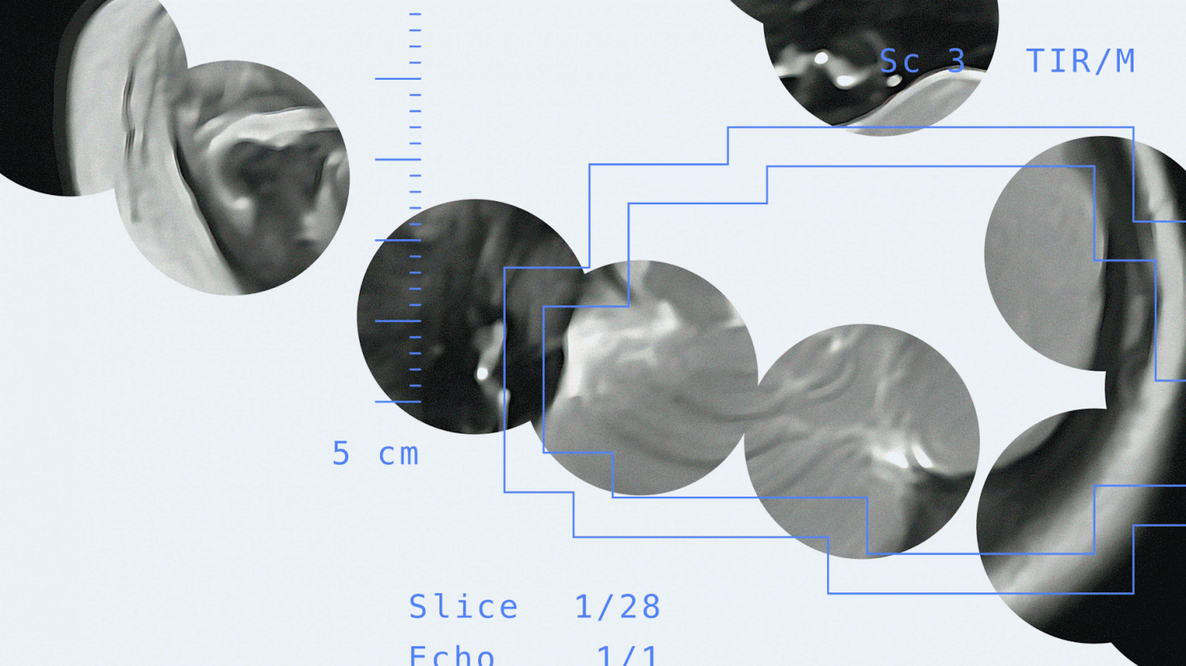 featured image - Researchers Develop AI to Spot Early Signs of Cerebral Palsy in Infants