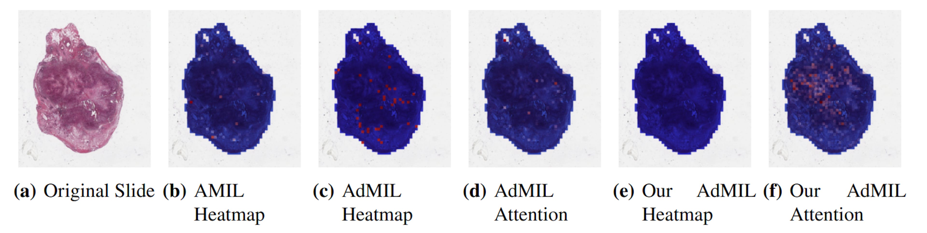 Figure 9: Heatmaps produced by the models for slide cf1ee3be-f161-4614-b2dd-030a9adfc5fc for the gene mutation detection task at 20x magnification. (a) Slide at thumbnail level; (b) AMIL attention scores; (c) AdMIL’s final patch scores; (d) AdMIL’s attention scores; (e) Our version of AdMIL’s final patch scores; (f) Our version of AdMIL’s attention scores.