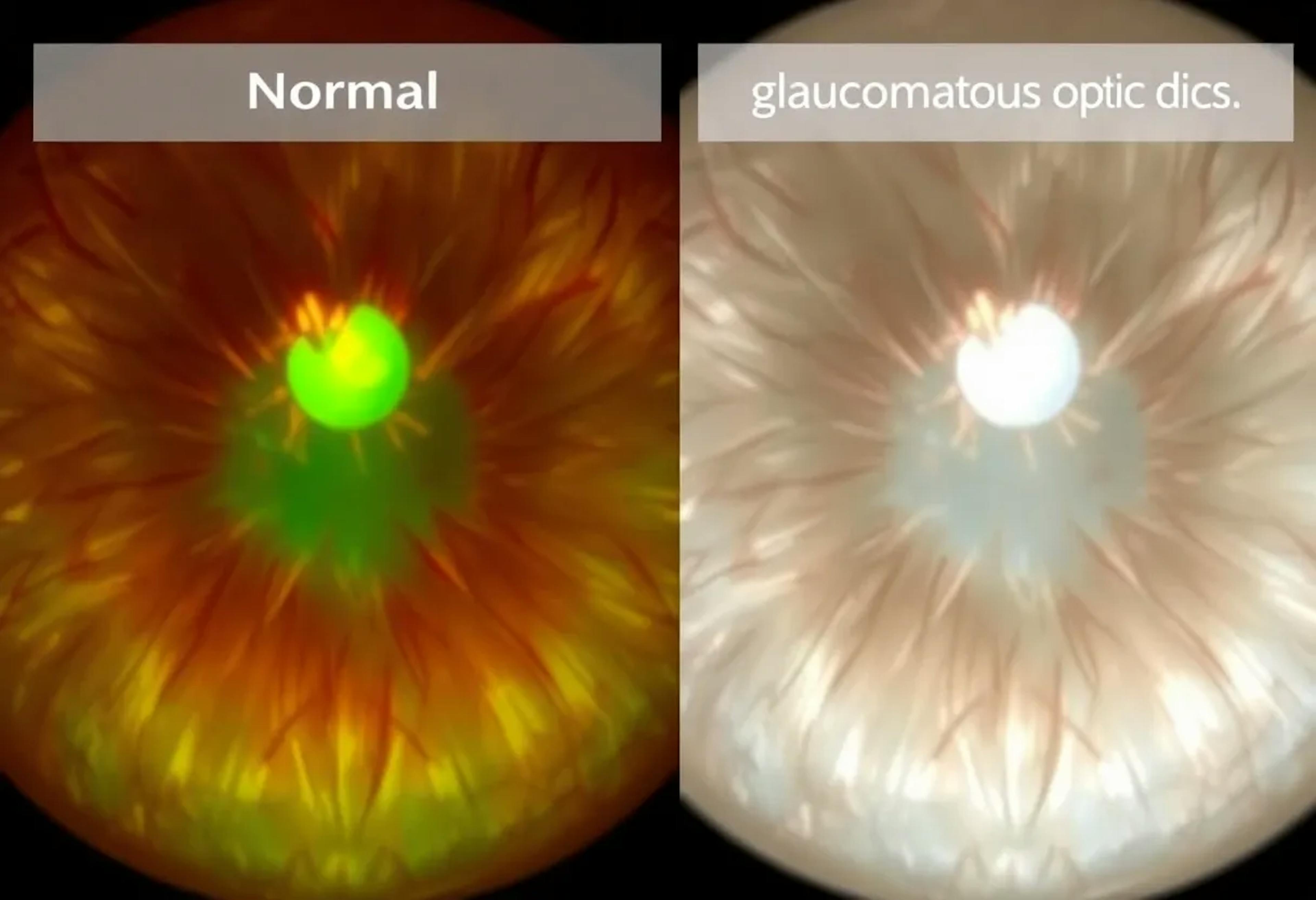 Advancing Glaucoma Diagnostics With Functional And Structural OCT advancing-glaucoma-diagnostics-with-functional-and-structural-oct