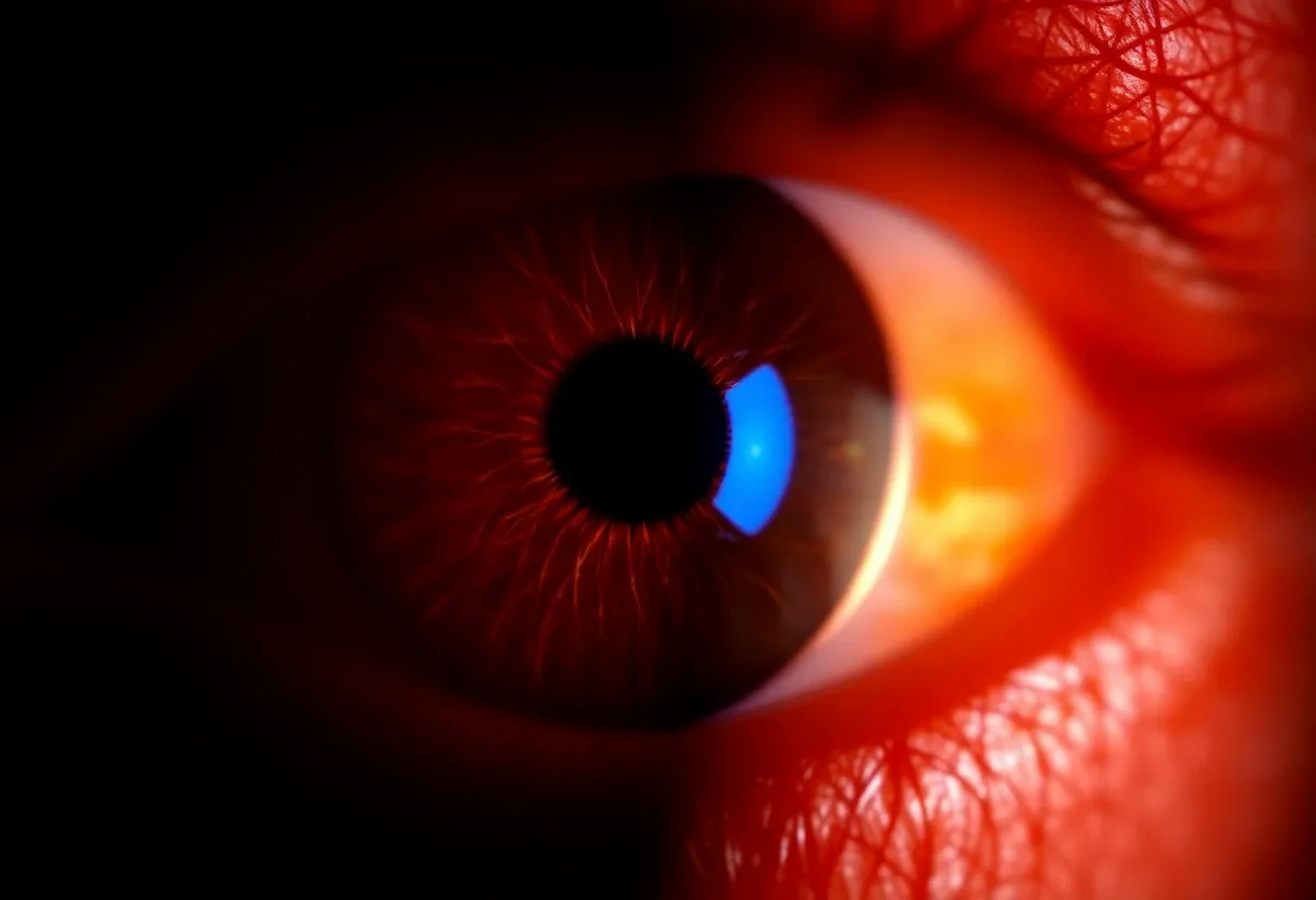 featured image - Improving OCT Diagnostic Accuracy with NFL/Post-NFL Bright Correction